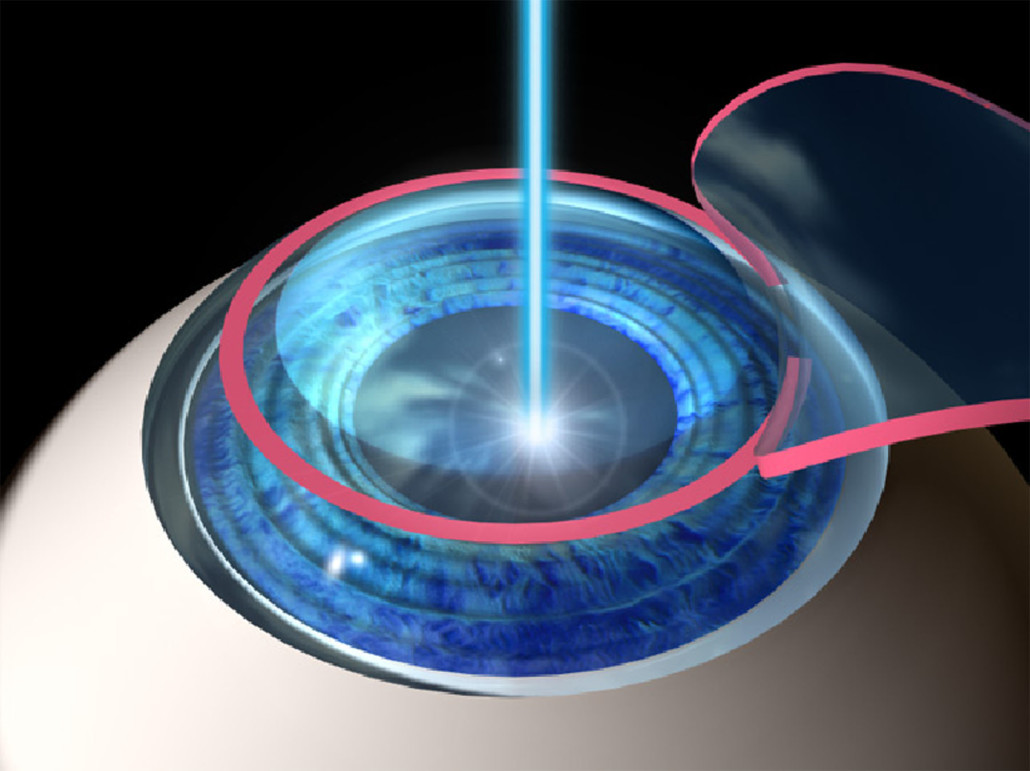 LASIK surgery Insurance
