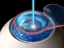 LASIK surgery Insurance